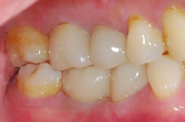 植牙成功關鍵，要美觀更要兼顧穩定性！！