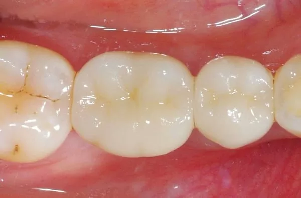 植牙成功關鍵，要美觀更要兼顧穩定性！！