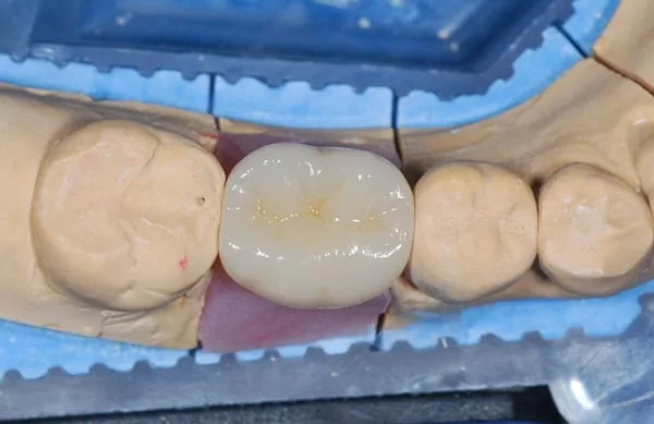 植牙成功關鍵，要美觀更要兼顧穩定性！！