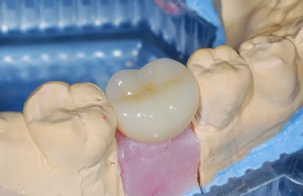 植牙成功關鍵，要美觀更要兼顧穩定性！！