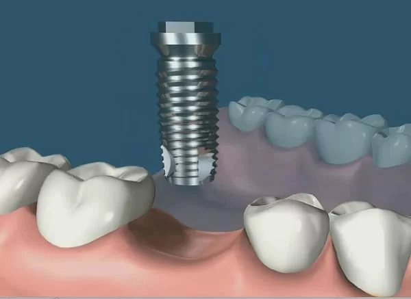 植牙成功關鍵，要美觀更要兼顧穩定性！！
