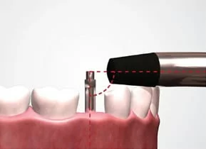 植牙成功關鍵，要美觀更要兼顧穩定性！！