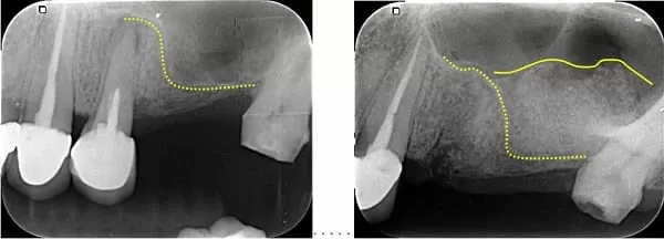 微創手術 - 施行&quot;鼻竇增高術&quot;降低疼痛及腫脹