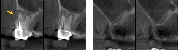 微創手術 - 施行&quot;鼻竇增高術&quot;降低疼痛及腫脹