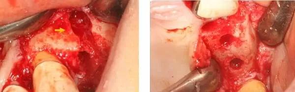 微創手術 - 施行&quot;鼻竇增高術&quot;降低疼痛及腫脹