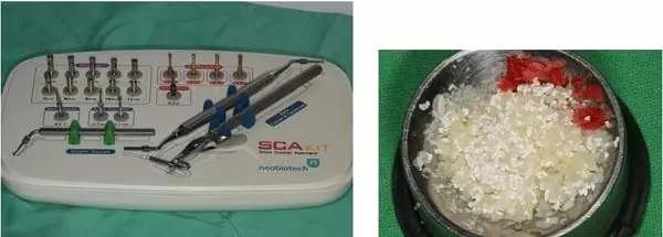 微創手術 - 施行&quot;鼻竇增高術&quot;降低疼痛及腫脹