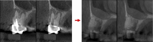 微創手術 - 施行&quot;鼻竇增高術&quot;降低疼痛及腫脹