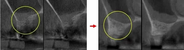 微創手術 - 施行&quot;鼻竇增高術&quot;降低疼痛及腫脹