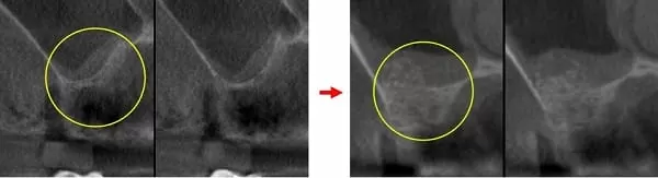 微創手術 - 施行&quot;鼻竇增高術&quot;降低疼痛及腫脹