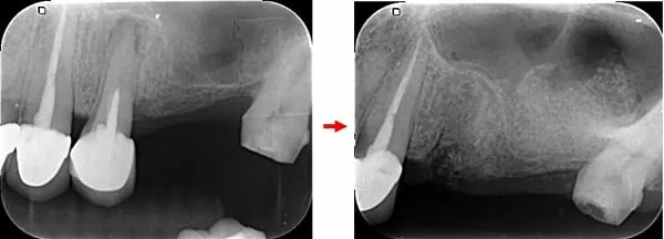 微創手術 - 施行&quot;鼻竇增高術&quot;降低疼痛及腫脹