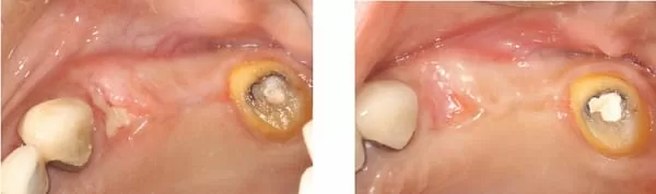 微創手術 - 施行&quot;鼻竇增高術&quot;降低疼痛及腫脹