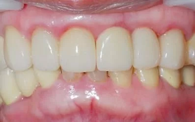 【門牙微創植牙】即拔即種,立即擁有假牙套 【門牙微創植牙】即拔即種,立即擁有假牙套