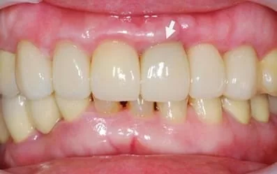 【門牙微創植牙】即拔即種,立即擁有假牙套 【門牙微創植牙】即拔即種,立即擁有假牙套