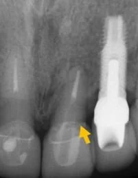 【門牙微創植牙】即拔即種,立即擁有假牙套 【門牙微創植牙】即拔即種,立即擁有假牙套