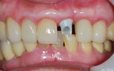 【門牙微創植牙】即拔即種,立即擁有假牙套 【門牙微創植牙】即拔即種,立即擁有假牙套