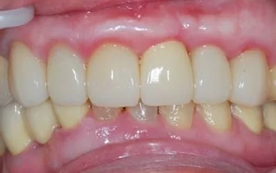 【門牙微創植牙】即拔即種,立即擁有假牙套 【門牙微創植牙】即拔即種,立即擁有假牙套