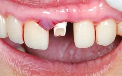 【門牙微創植牙】即拔即種,立即擁有假牙套 【門牙微創植牙】即拔即種,立即擁有假牙套