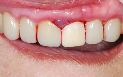 【門牙微創植牙】即拔即種,立即擁有假牙套 【門牙微創植牙】即拔即種,立即擁有假牙套