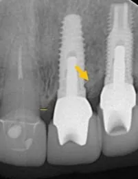 【門牙微創植牙】即拔即種,立即擁有假牙套 【門牙微創植牙】即拔即種,立即擁有假牙套
