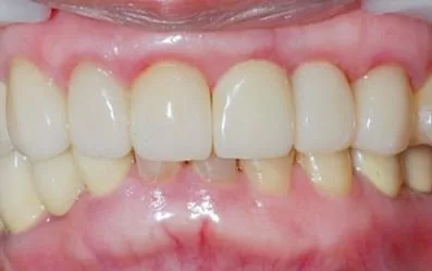 【門牙微創植牙】即拔即種,立即擁有假牙套 【門牙微創植牙】即拔即種,立即擁有假牙套