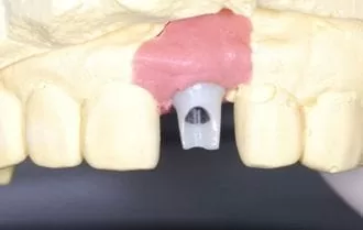 【門牙微創植牙】即拔即種,立即擁有假牙套 【門牙微創植牙】即拔即種,立即擁有假牙套