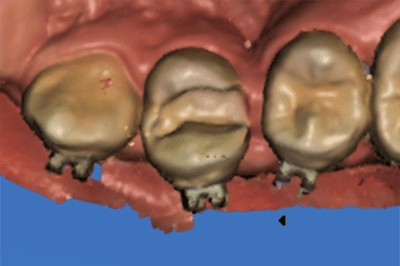 proimages/case/case-intro/implantology/implantology09/3.png