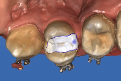 proimages/case/case-intro/implantology/implantology09/4.png