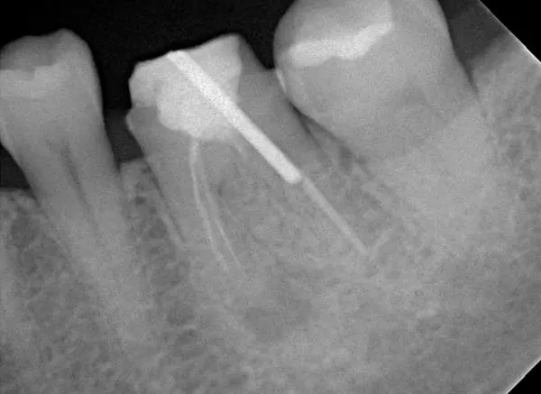 高倍數顯微鏡設備在根管治療所扮演的重要角色 高倍數顯微鏡設備在根管治療所扮演的重要角色