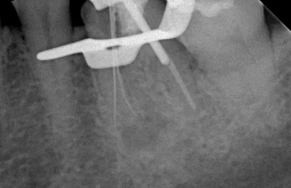 高倍數顯微鏡設備在根管治療所扮演的重要角色 高倍數顯微鏡設備在根管治療所扮演的重要角色