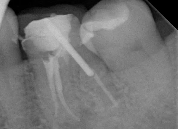高倍數顯微鏡設備在根管治療所扮演的重要角色 高倍數顯微鏡設備在根管治療所扮演的重要角色
