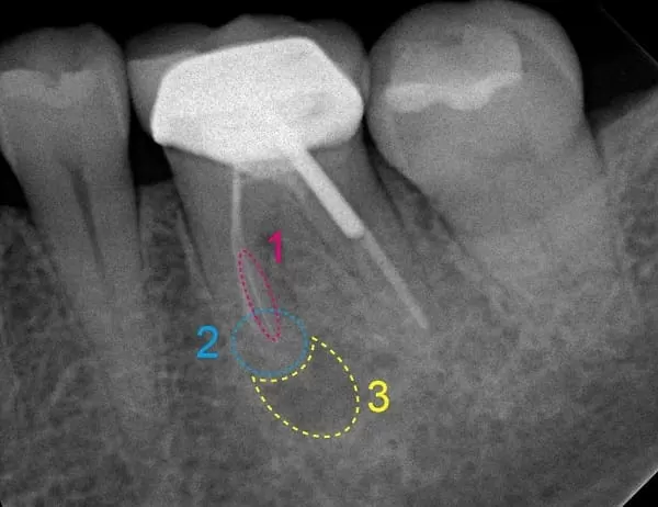 高倍數顯微鏡設備在根管治療所扮演的重要角色 高倍數顯微鏡設備在根管治療所扮演的重要角色