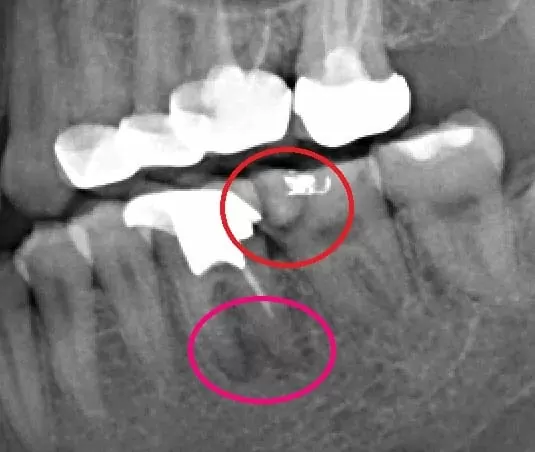 根管慢性發炎與根管鈣化之顯微鏡輔助根管治療