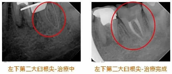 根管慢性發炎與根管鈣化之顯微鏡輔助根管治療
