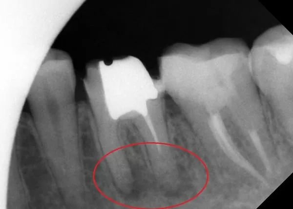 根管慢性發炎與根管鈣化之顯微鏡輔助根管治療