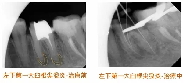 根管慢性發炎與根管鈣化之顯微鏡輔助根管治療