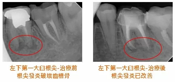 根管慢性發炎與根管鈣化之顯微鏡輔助根管治療