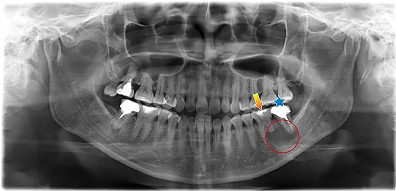 X光片顯示不明的黑色陰影 骨頭被細菌吃掉了 怎麼辦? X光片顯示不明的黑色陰影 骨頭被細菌吃掉了 怎麼辦?