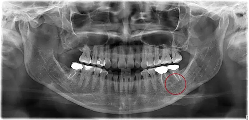 X光片顯示不明的黑色陰影 骨頭被細菌吃掉了 怎麼辦? X光片顯示不明的黑色陰影 骨頭被細菌吃掉了 怎麼辦?