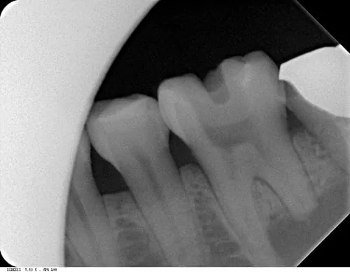 X光片顯示不明的黑色陰影 骨頭被細菌吃掉了 怎麼辦? X光片顯示不明的黑色陰影 骨頭被細菌吃掉了 怎麼辦?