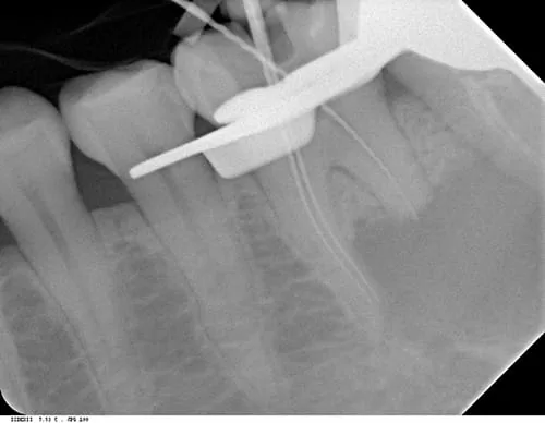 X光片顯示不明的黑色陰影 骨頭被細菌吃掉了 怎麼辦? X光片顯示不明的黑色陰影 骨頭被細菌吃掉了 怎麼辦?