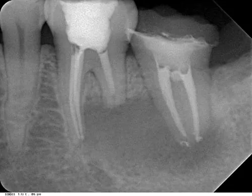 X光片顯示不明的黑色陰影 骨頭被細菌吃掉了 怎麼辦? X光片顯示不明的黑色陰影 骨頭被細菌吃掉了 怎麼辦?