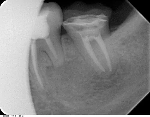 X光片顯示不明的黑色陰影 骨頭被細菌吃掉了 怎麼辦? X光片顯示不明的黑色陰影 骨頭被細菌吃掉了 怎麼辦?