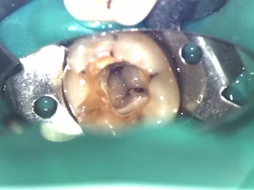 X光片顯示不明的黑色陰影 骨頭被細菌吃掉了 怎麼辦? X光片顯示不明的黑色陰影 骨頭被細菌吃掉了 怎麼辦?