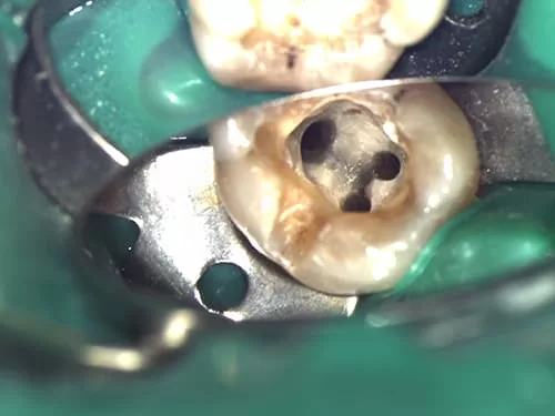 X光片顯示不明的黑色陰影 骨頭被細菌吃掉了 怎麼辦? X光片顯示不明的黑色陰影 骨頭被細菌吃掉了 怎麼辦?