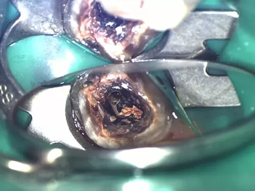 X光片顯示不明的黑色陰影 骨頭被細菌吃掉了 怎麼辦? X光片顯示不明的黑色陰影 骨頭被細菌吃掉了 怎麼辦?