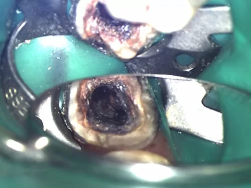 X光片顯示不明的黑色陰影 骨頭被細菌吃掉了 怎麼辦? X光片顯示不明的黑色陰影 骨頭被細菌吃掉了 怎麼辦?