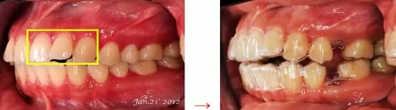 隱形矯正－牙齒矯正讓臉形變更美了