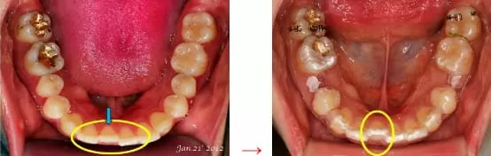 隱形矯正－牙齒矯正讓臉形變更美了