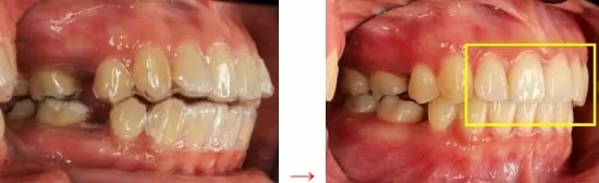 隱形矯正－牙齒矯正讓臉形變更美了