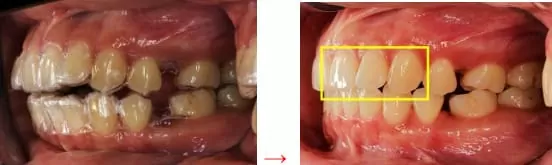 隱形矯正－牙齒矯正讓臉形變更美了
